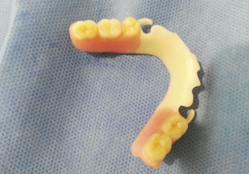 Protesis sin metal