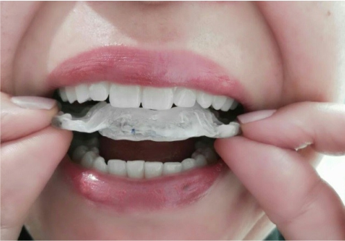 Splint Reposicionador