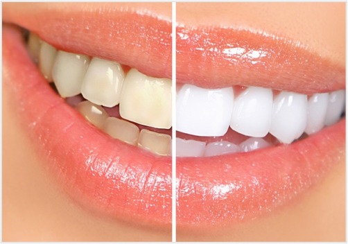Blanqueamiento dental