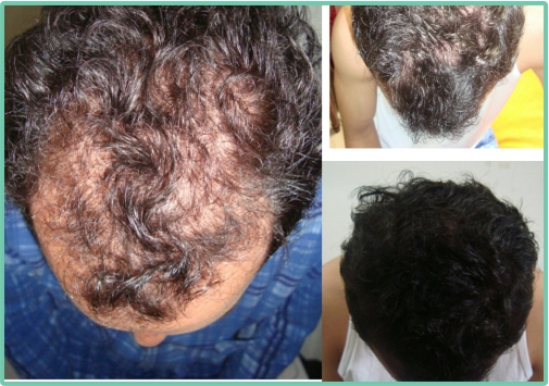 Eliminar Acne